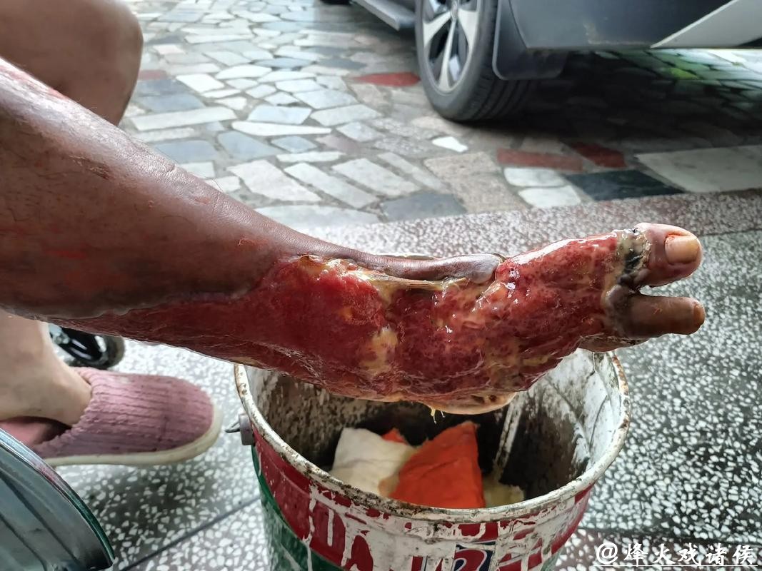 熏蒸足部竟致深度溃烂专家提醒: 糖尿病患者需警惕“温暖陷阱”